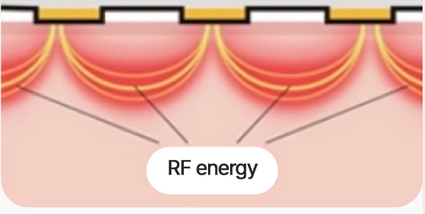 Density 雙重 RF 原理圖示