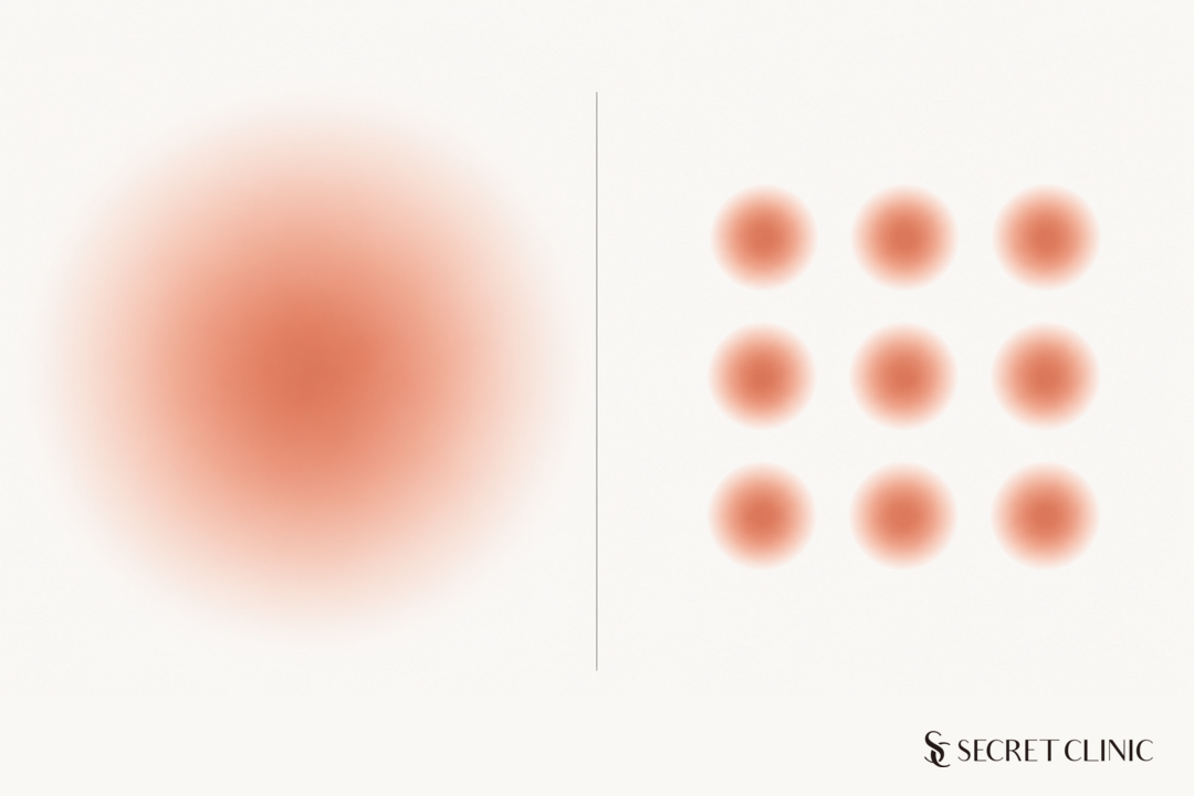 03_Thermage_RF_Ultrasound_Heat_Pattern_Korea.png