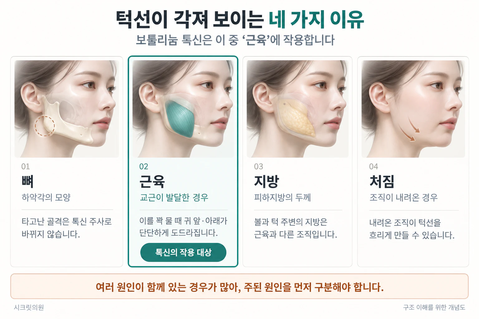 사각턱 보톡스_01