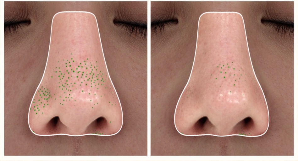 Sylfirm X before-and-after comparison photo · Nose close-up · Before 2025.12 · After 2026.06