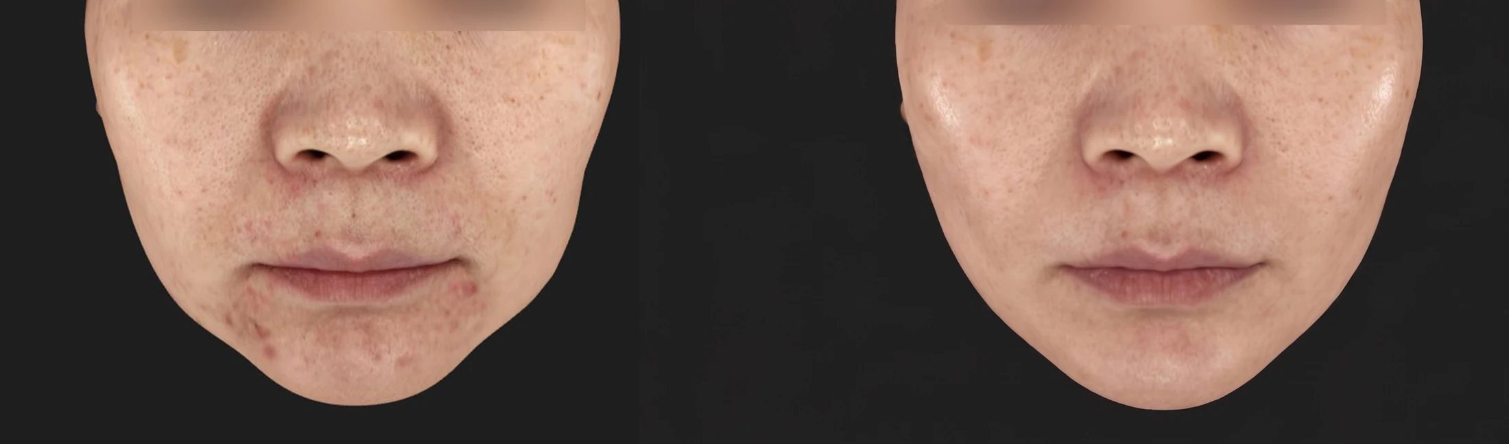 Thermage FLX before & after photos 1 — Before / After