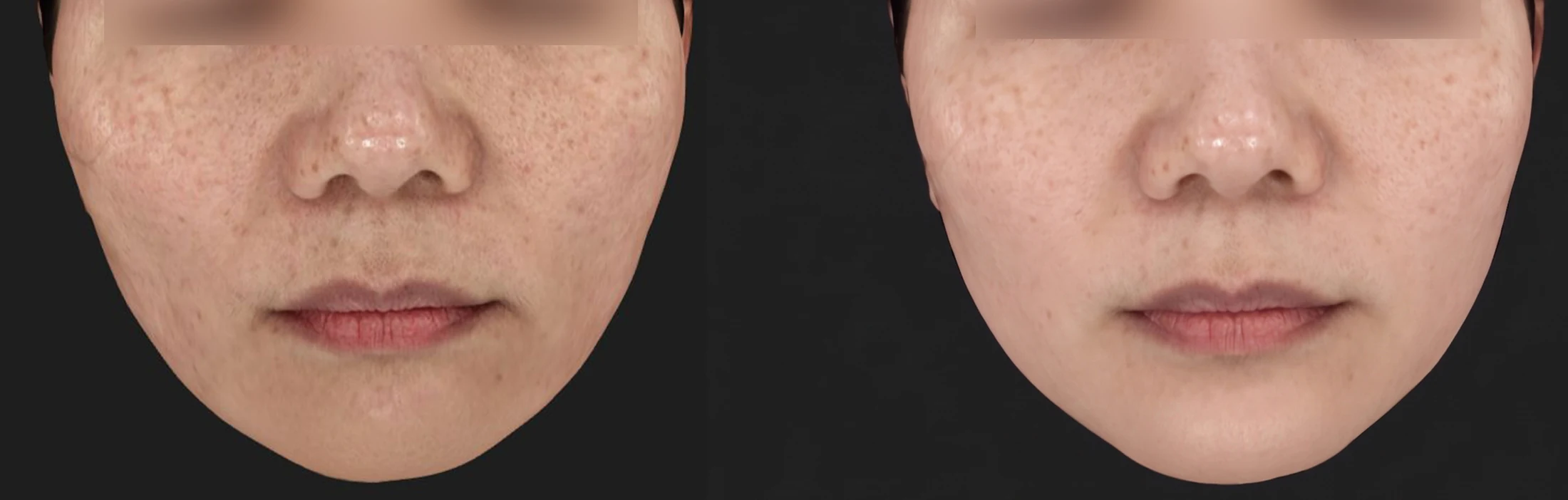 Thermage FLX before & after photos 2 — Before / After