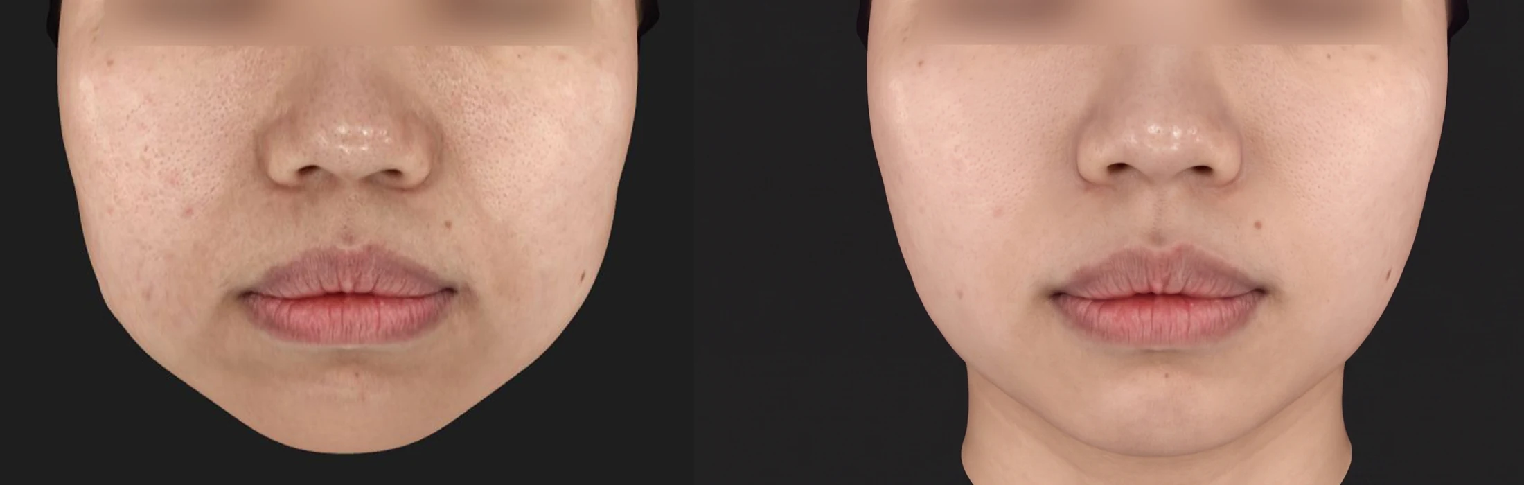 Thermage FLX before & after photos 3 — Before / After