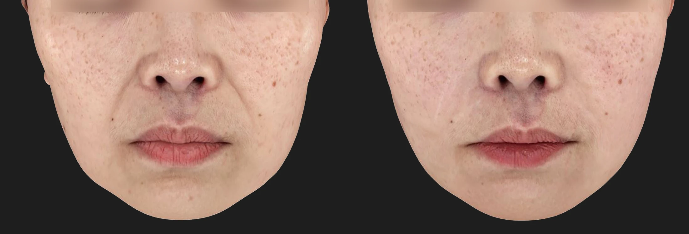 Thermage FLX before & after photos 4 — Before / After