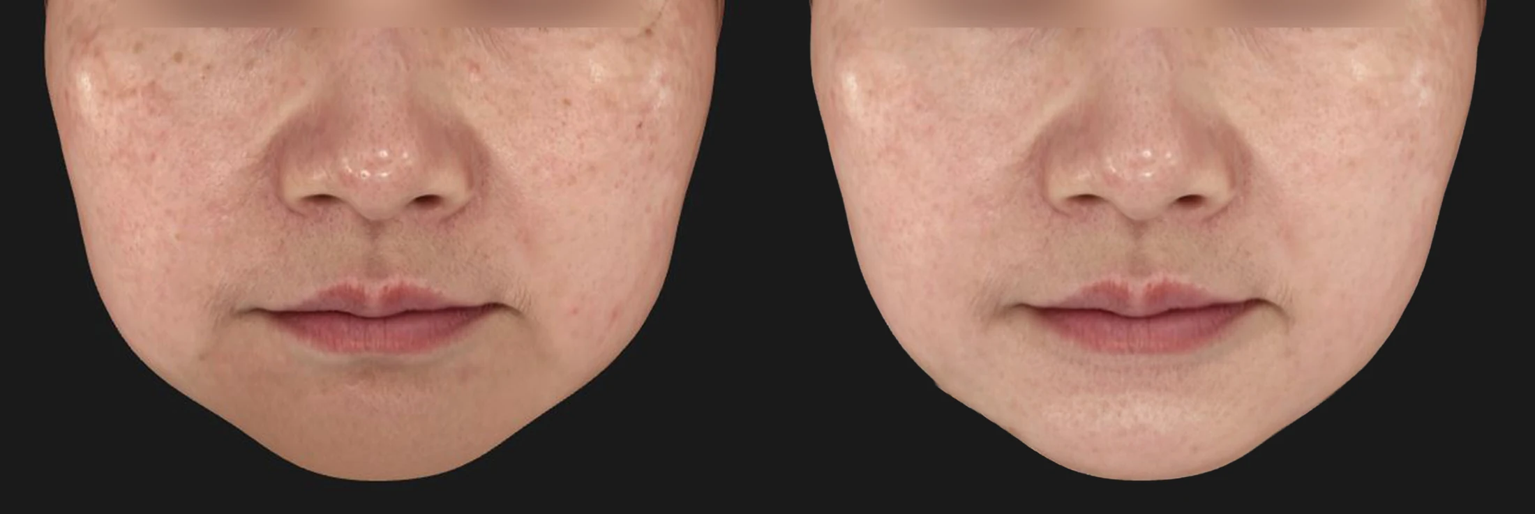 Thermage FLX before & after photos 5 — Before / After